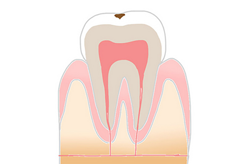 C1（エナメル質の虫歯）