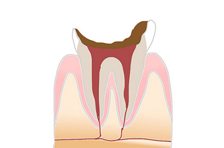虫歯はどのように進行する？進行度合いと治療方法について